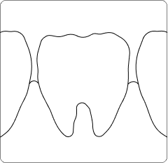 implants