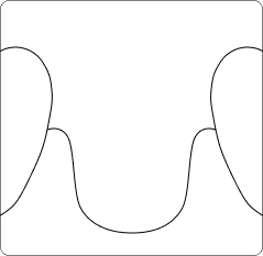 implants